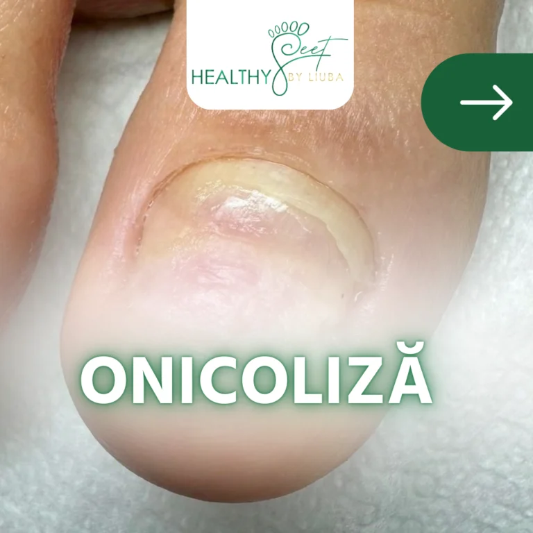 Onicoliza – ce înseamnă și de ce e important să nu o ignori