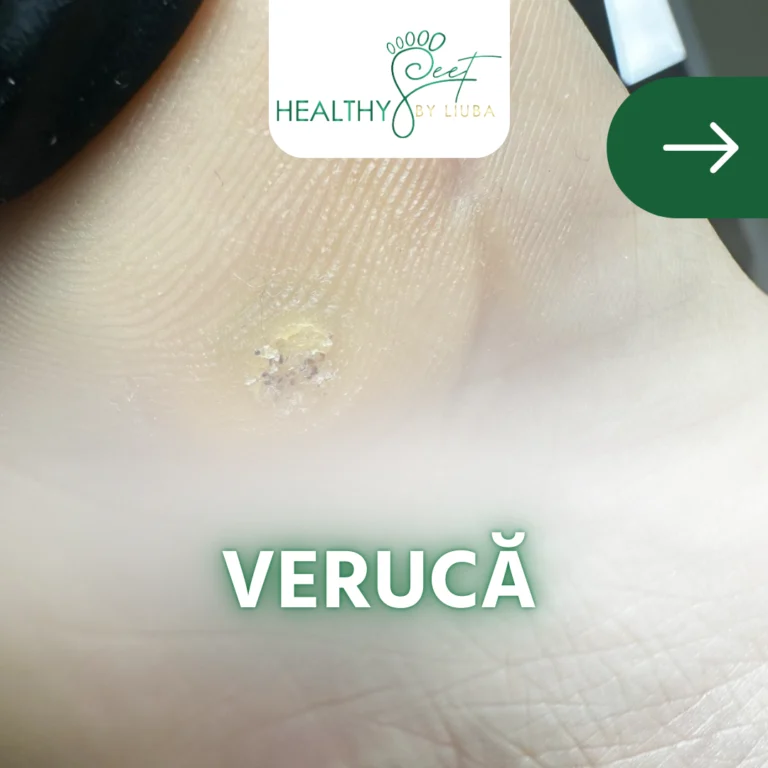 Verucile – de ce e important să le tratăm profesional, mai ales vara | Healthy Feet by Liuba